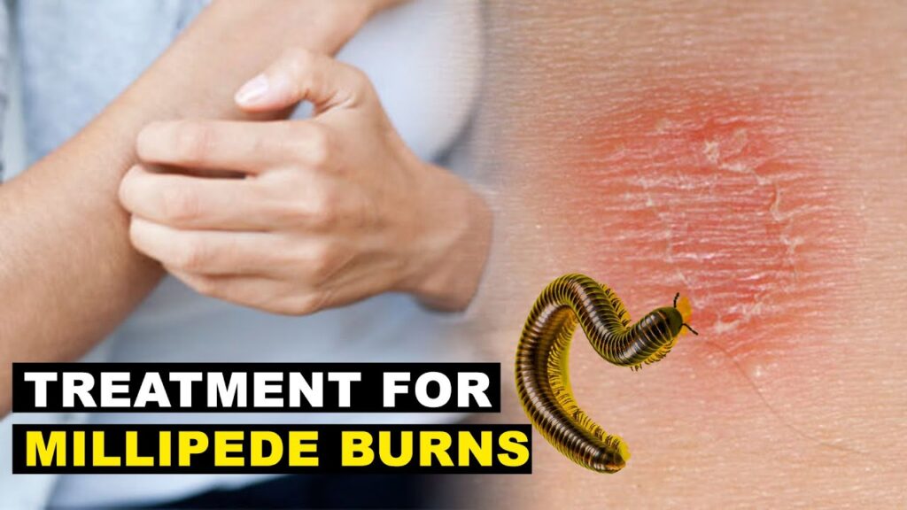 Best Treatment for Millipede Burns A Guide to Healthy Skin Recovery