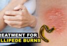 Best Treatment for Millipede Burns A Guide to Healthy Skin Recovery