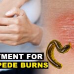 Best Treatment for Millipede Burns A Guide to Healthy Skin Recovery