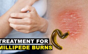 Best Treatment for Millipede Burns A Guide to Healthy Skin Recovery
