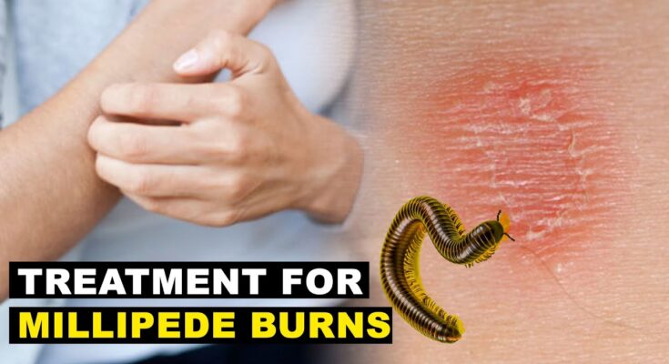 Best Treatment for Millipede Burns A Guide to Healthy Skin Recovery